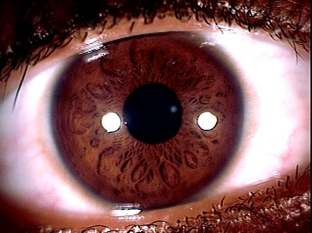 Foto of eye showing poor conditions